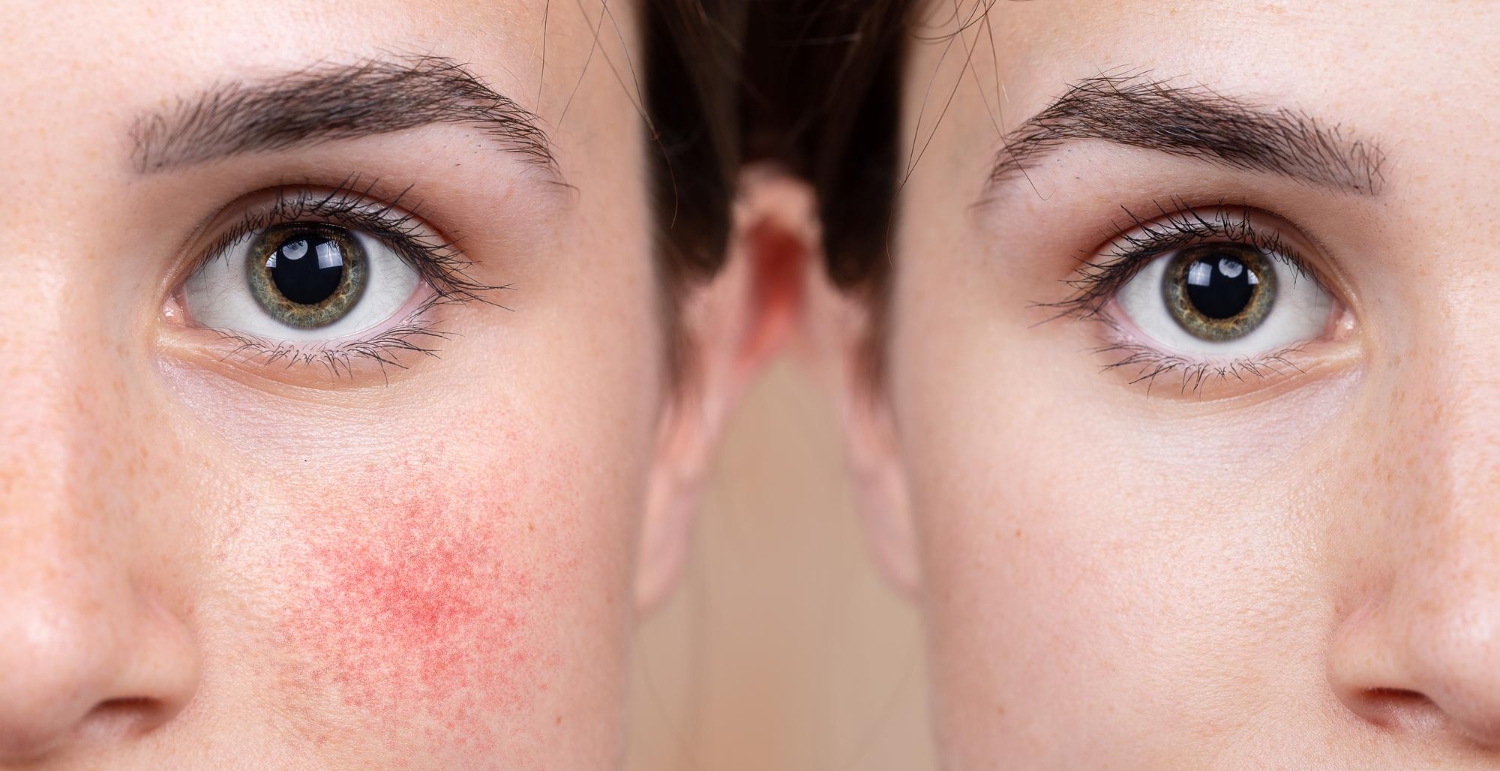 Laser Treatment For Rosacea: What Actually Works And What To Expect